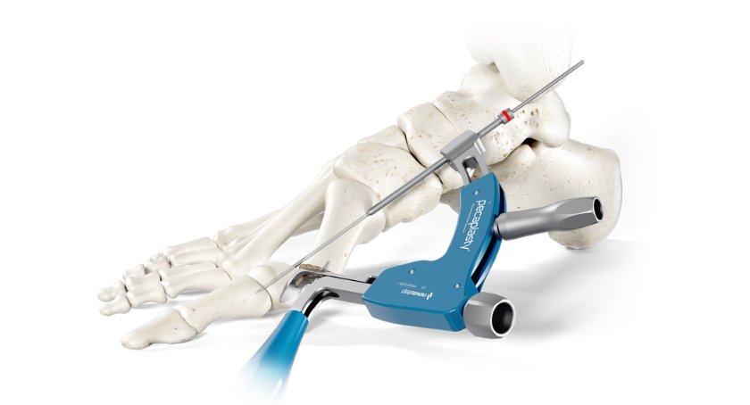 Enovis to Debut Pecaplasty ‘Wires First’ Bunion Surgery Tech